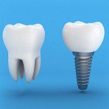 September is Dental Implant Awareness Month!